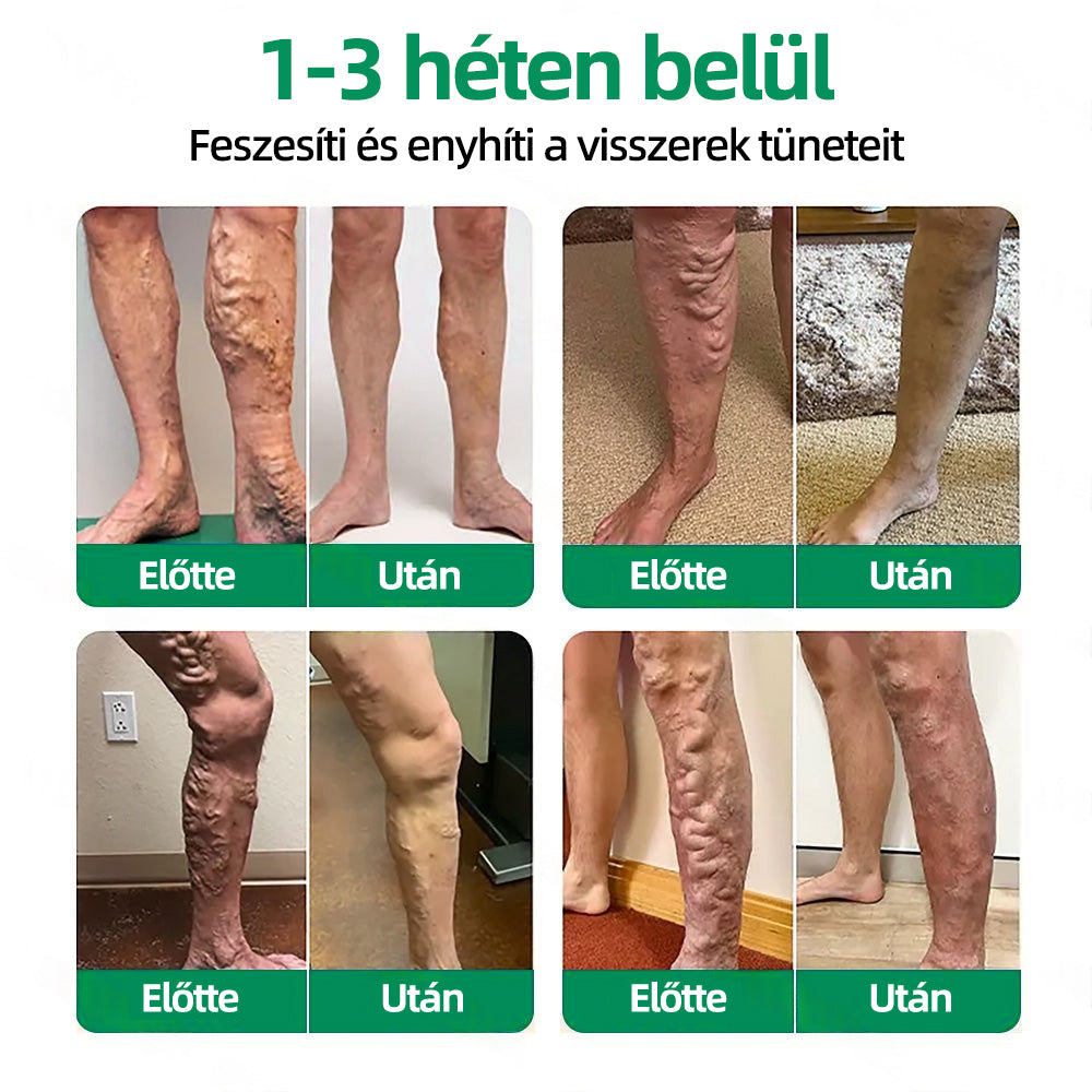 🇭🇺👩‍⚕️✅𝐇𝐞𝐚𝐥𝐫𝐢𝐳𝐞® VeinTarget mikrotűs tapasz⚡Azonnali enyhülés hosszú távú eredmények🔝