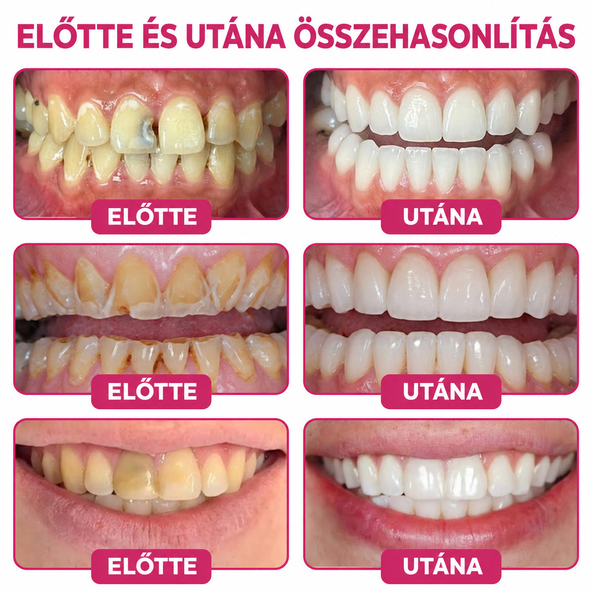🧚‍♀️☘️🦷HEATWOLF® DenPerm – Természetes fogzománc-töltő gél a fogszuvasodás helyreállítására