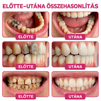 🧚‍♀️☘️🦷HEATWOLF® DenPerm – Természetes fogzománc-töltő gél a fogszuvasodás helyreállítására