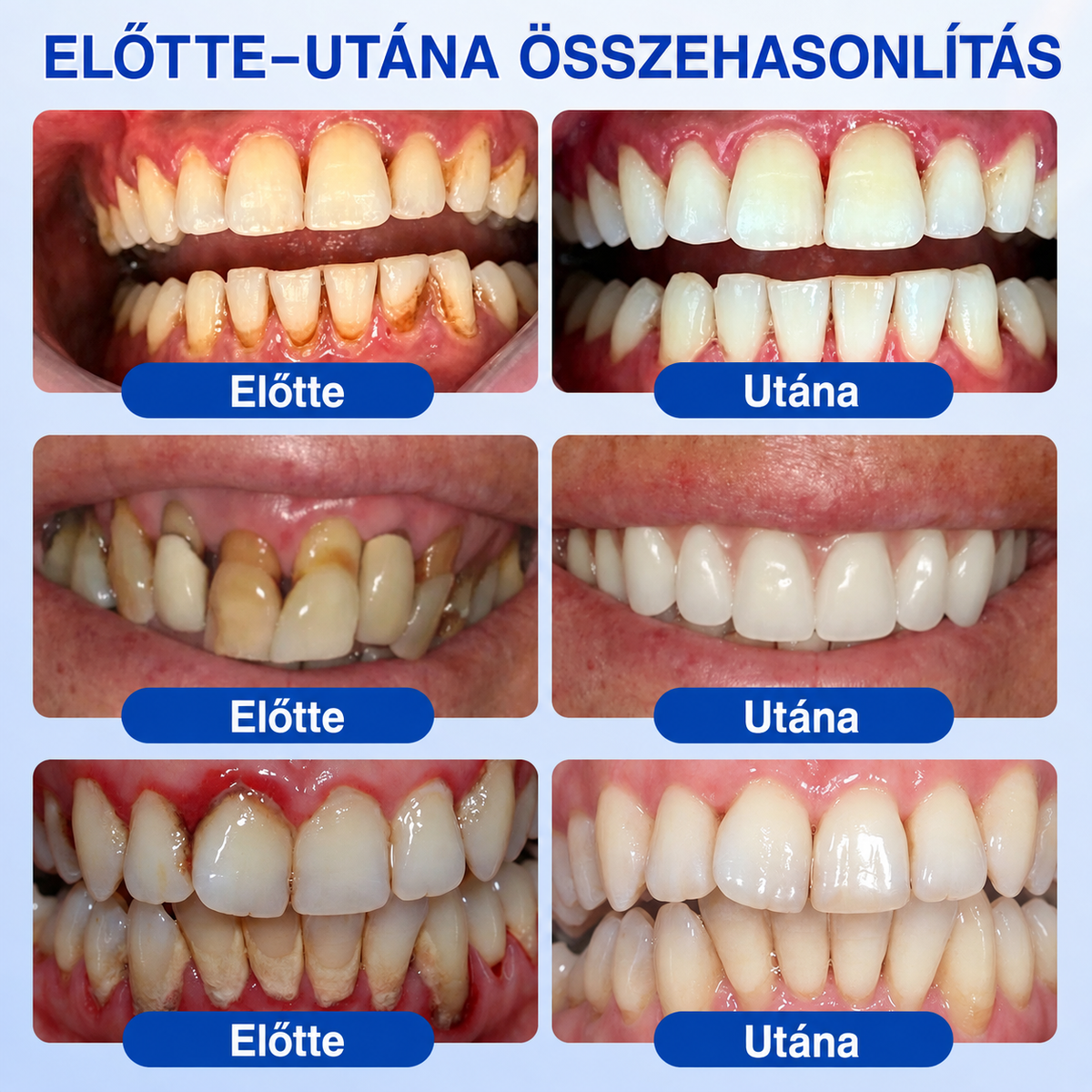 🇭🇺👨‍⚕️✅🦷 HEATWOLF® GumRevive – Parodontális helyreállító gél✨2️⃣